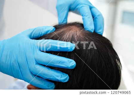Doctor touch bold head in man, hair loss treatment health problem. 120749065