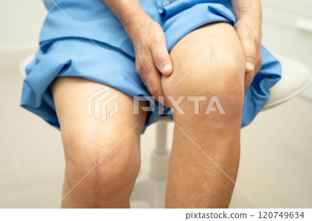 Asian elderly woman patient with scar knee replacement surgery in hospital. Asian elderly woman patient with scar knee replacement surgery in hospital. 120749634