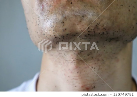 Japanese man's skin immediately after laser hair removal 120749791