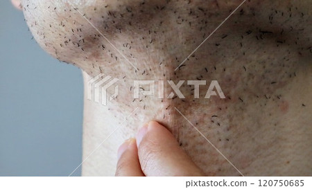 A Japanese man's neck immediately after laser hair removal 120750685