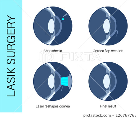 LASIK eye surgery 120767765