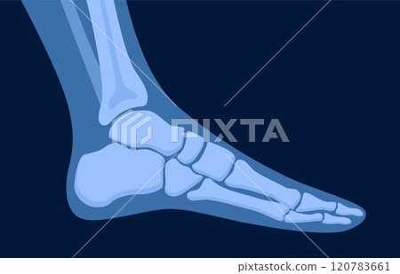 X ray human foot. X-ray picture or radiographic monitor image of metatarsus bones and toes. Medical radiology. Vector illustration. 120783661