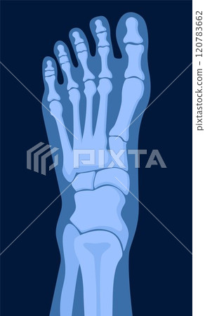 X ray human foot. X-ray picture or radiographic monitor image of metatarsus bones and toes. Medical radiology. Vector illustration. X ray human foot. X-ray picture or radiographic monitor image of metatarsus bones and toes. Medical radiology. Vector illustration. 120783662
