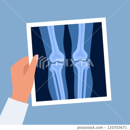 Xray of human knees bones and joints, examination and diagnosis. Roentgen shot in doctors hand. Vector illustration. Xray of human knees bones and joints, examination and diagnosis. Roentgen shot in doctors hand. Vector illustration. 120783671