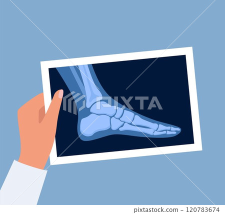 X ray human foot. X-ray picture or radiographic monitor image of metatarsus bones and toes. Medical radiology. Roentgen shot in doctors hand. Vector illustration. X ray human foot. X-ray picture or radiographic monitor image of metatarsus bones and toes. Medical radiology. Roentgen shot in doctors hand. Vector illustration. 120783674