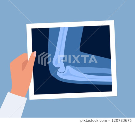 Xray scan of elbow joint. Anatomical structure, care and diagnosis for pain in arm. Roentgen shot in doctors hand. Vector illustration. Xray scan of elbow joint. Anatomical structure, care and diagnosis for pain in arm. Roentgen shot in doctors hand. Vector illustration. 120783675