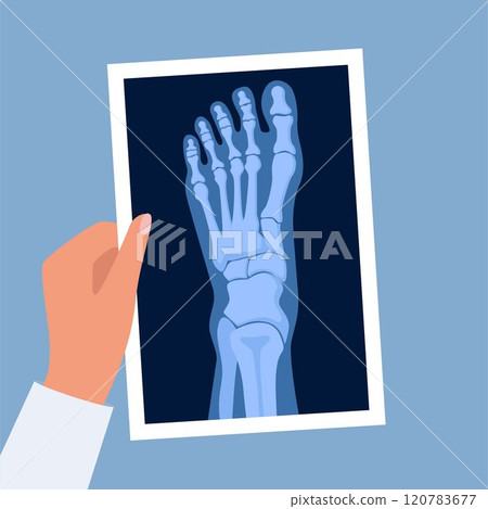 X ray human foot. X-ray picture or radiographic monitor image of metatarsus bones and toes. Medical radiology. Roentgen shot in doctors hand. Vector illustration. X ray human foot. X-ray picture or radiographic monitor image of metatarsus bones and toes. Medical radiology. Roentgen shot in doctors hand. Vector illustration. 120783677