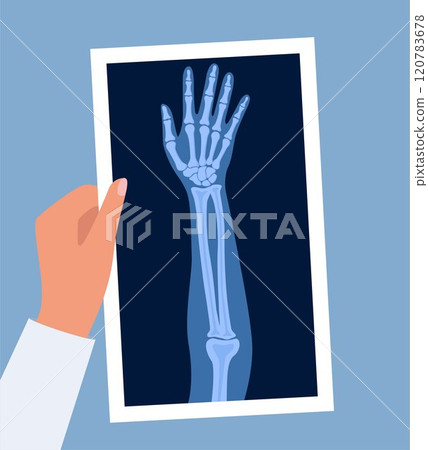 X ray human hand. Body bone roentgen front view. Medical anatomy. Arm checking healthcare joint palm finger exam. Roentgen shot in doctors hand. Vector illustration. X ray human hand. Body bone roentgen front view. Medical anatomy. Arm checking healthcare joint palm finger exam. Roentgen shot in doctors hand. Vector illustration. 120783678