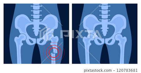 X ray of femur fracture with red pain point. Broken leg with open type of fracture. Human skeleton anatomy concept. Medical banner for clinic or hospital. Vector illustration X ray of femur fracture with red pain point. Broken leg with open type of fracture. Human skeleton anatomy concept. Medical banner for clinic or hospital. Vector illustration 120783681