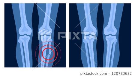 X ray of leg fracture with red pain point. Broken leg with open type of fracture. Human skeleton anatomy concept. Medical banner for clinic or hospital. Vector illustration X ray of leg fracture with red pain point. Broken leg with open type of fracture. Human skeleton anatomy concept. Medical banner for clinic or hospital. Vector illustration 120783682