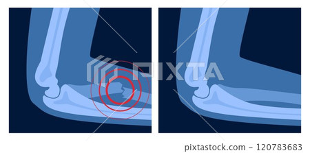 X ray of arm fracture with red pain point. Broken hand with open type of fracture. Human skeleton anatomy concept. Medical banner for clinic or hospital. Vector illustration X ray of arm fracture with red pain point. Broken hand with open type of fracture. Human skeleton anatomy concept. Medical banner for clinic or hospital. Vector illustration 120783683
