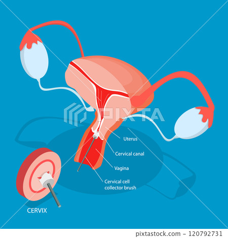 3D Isometric Flat Vector Illustration of Pap Test, Process Of Conducting A Pap Testing To Detect Abnormal Cells In The Cervix 3D Isometric Flat Vector Illustration of Pap Test, Process Of Conducting A Pap Testing To Detect Abnormal Cells In The Cervix 120792731