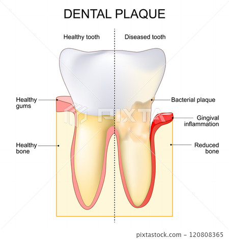 Dental plaque. Gingival inflammation. Close-up of a Tooth 120808365
