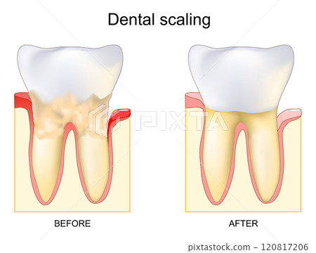 Dental calculus. Professional cleaning or scaling. removing tartar Dental calculus. Professional cleaning or scaling. removing tartar 120817206