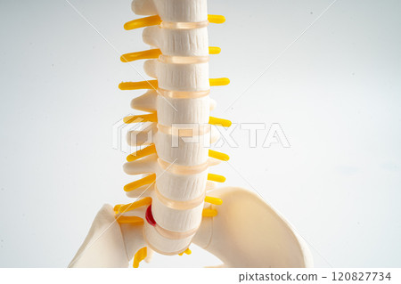 Lumbar spine displaced herniated disc fragment, spinal nerve and bone. Model for treatment medical in the orthopedic department. 120827734