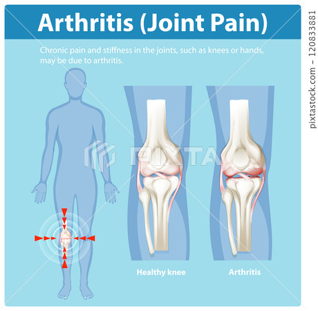 Understanding Arthritis and Joint Pain Understanding Arthritis and Joint Pain 120833881