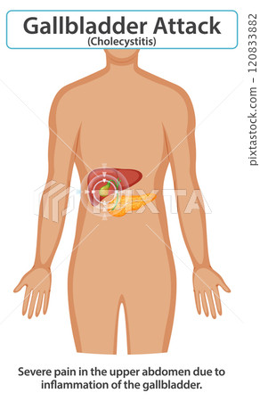 Understanding Gallbladder Attack Symptoms 120833882