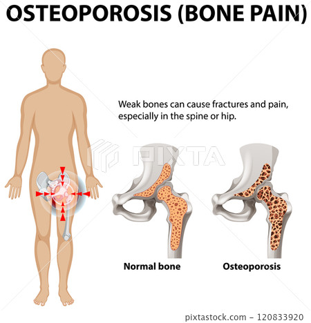 Understanding Osteoporosis and Bone Pain 120833920