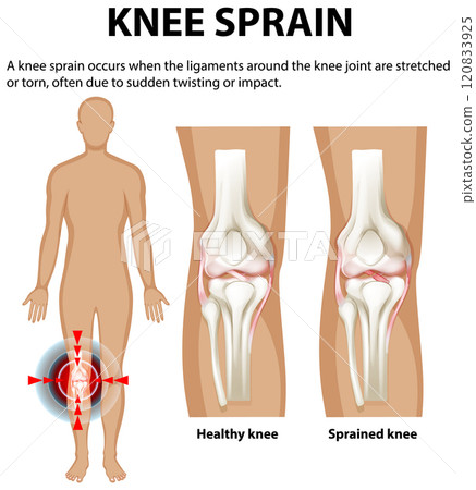 Understanding Knee Sprain and Ligament Injury 120833925