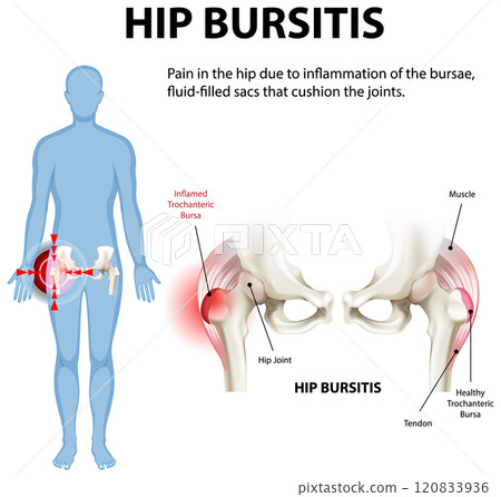 Understanding Hip Bursitis and Its Effects 120833936