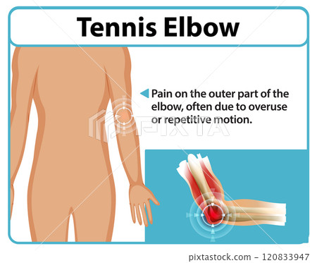 Understanding Tennis Elbow Pain 120833947