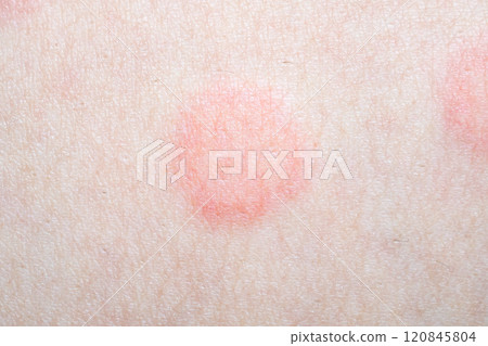 Skin allergy rash dermatitis texture close up Skin allergy rash dermatitis texture close up 120845804