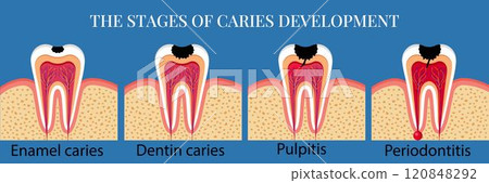 Stages of caries development with text Stages of caries development with text 120848292