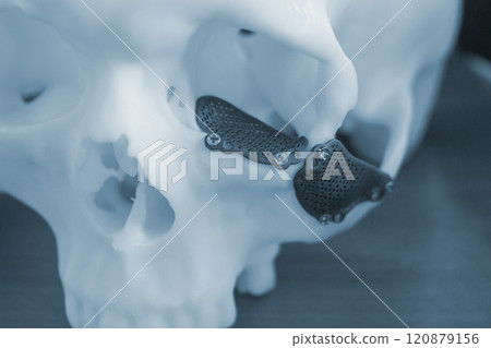 Proto-human skull from white plastic with titanium implants in form of plates and surgical templates printed on 3D printer. Biointegrated prosthesis Proto-human skull from white plastic with titanium implants in form of plates and surgical templates printed on 3D printer. Biointegrated prosthesis 120879156