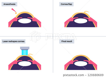 LASIK eye surgery 120880689
