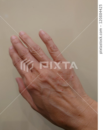 手背有濕疹 手背有濕疹 120884425
