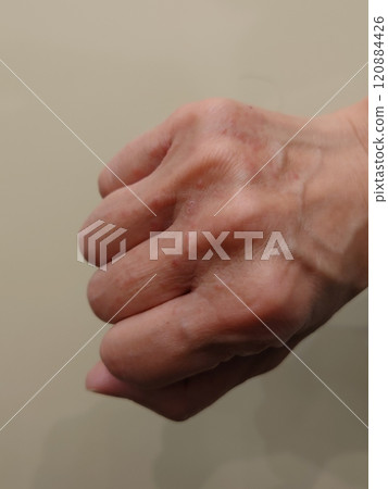 手背有濕疹 手背有濕疹 120884426