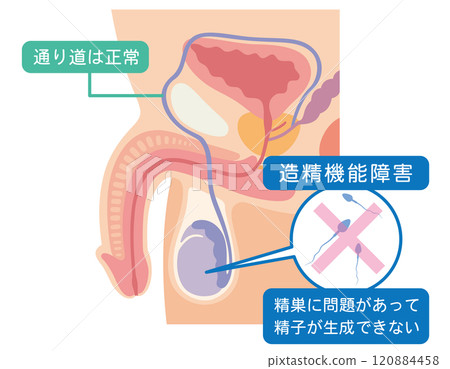 Spermatogenesis disorder, causes of male infertility, infertility, reproductive medicine 120884458