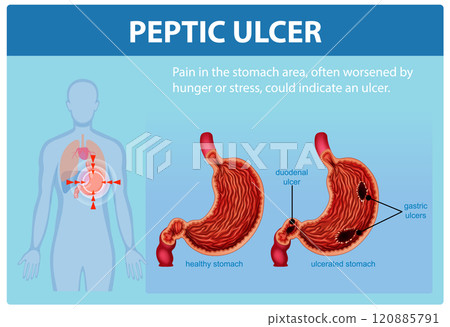 Understanding Peptic Ulcers and Symptoms 120885791