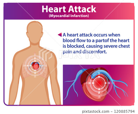 Understanding Heart Attack Symptoms and Causes 120885794