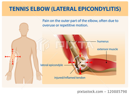 Understanding Tennis Elbow and Its Causes 120885798