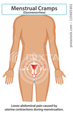 Understanding Menstrual Cramps and Dysmenorrhea 120885802