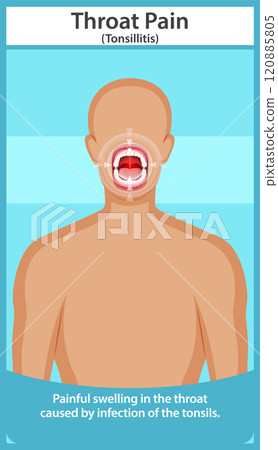Illustration of Throat Pain and Tonsillitis Illustration of Throat Pain and Tonsillitis 120885805