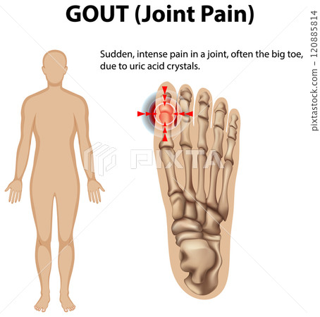 Understanding Gout and Joint Pain 120885814