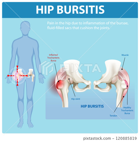 Understanding Hip Bursitis and Its Effects 120885819