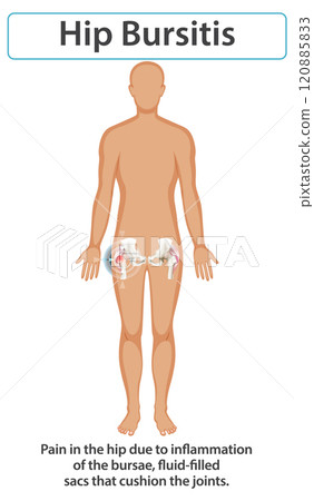 Understanding Hip Bursitis and Its Effects 120885833