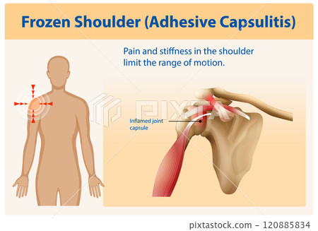 Understanding Frozen Shoulder Anatomy 120885834