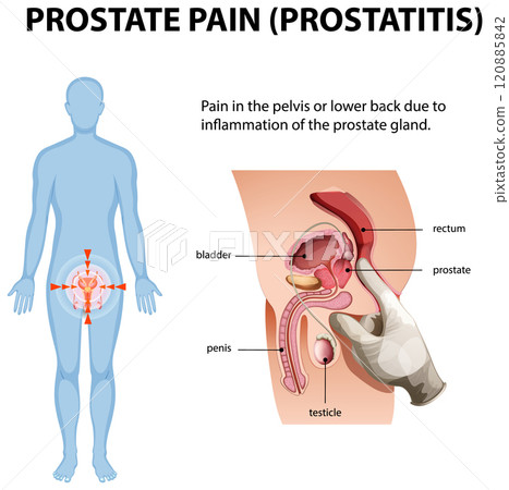 Understanding Prostate Pain and Inflammation Understanding Prostate Pain and Inflammation 120885842