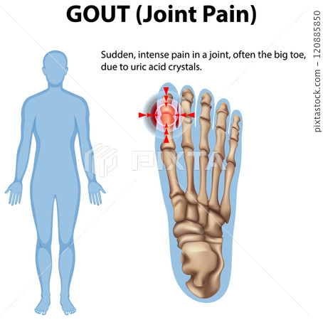 Understanding Gout and Joint Pain 120885850