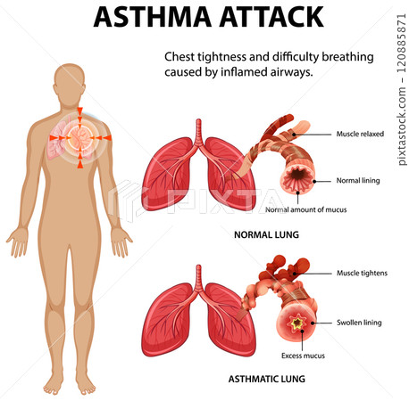Understanding Asthma and Its Effects 120885871
