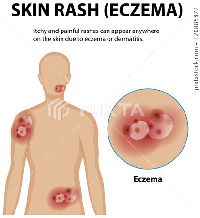 Understanding Eczema and Skin Rashes 120885872