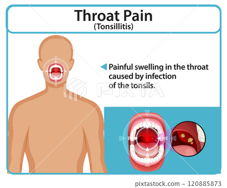Understanding Throat Pain and Tonsillitis Understanding Throat Pain and Tonsillitis 120885873