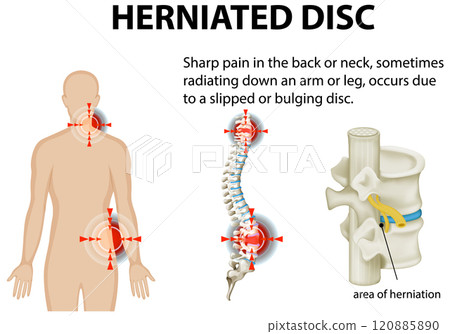 Understanding Herniated Disc Pain 120885890