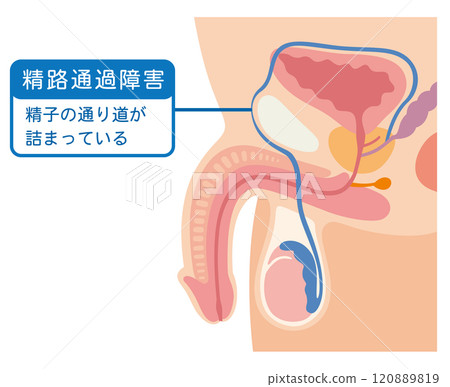 Sperm duct obstruction: Sperm passage is blocked Sperm duct obstruction: Sperm passage is blocked 120889819