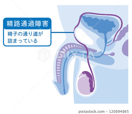 精子通道障礙：精子通道阻塞，男性不孕 120894865