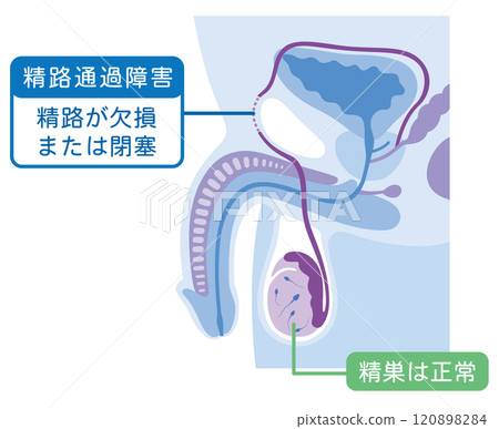 Sperm duct obstruction, sperm duct deficiency or blockage, male infertility Sperm duct obstruction, sperm duct deficiency or blockage, male infertility 120898284
